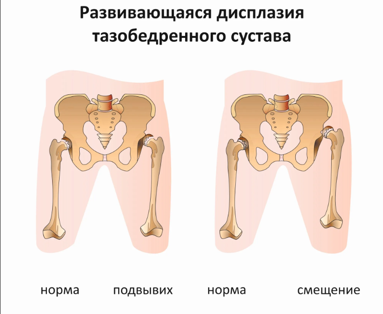 Признаки дисплазии у малыша
