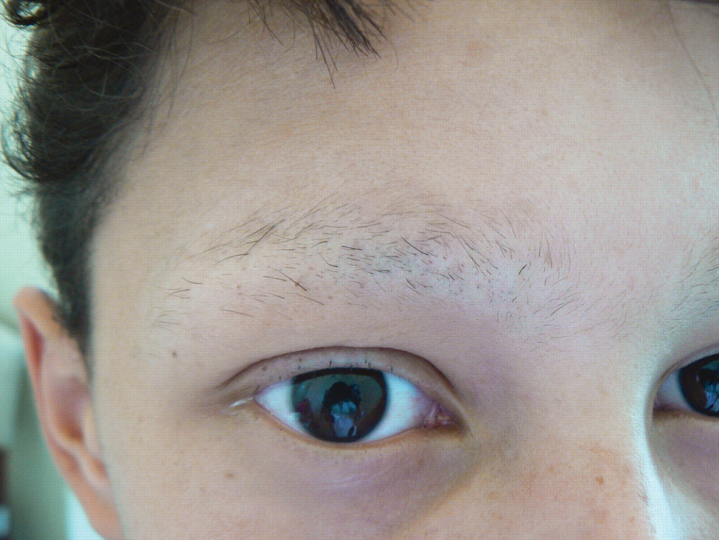 Выпадают брови и ресницы